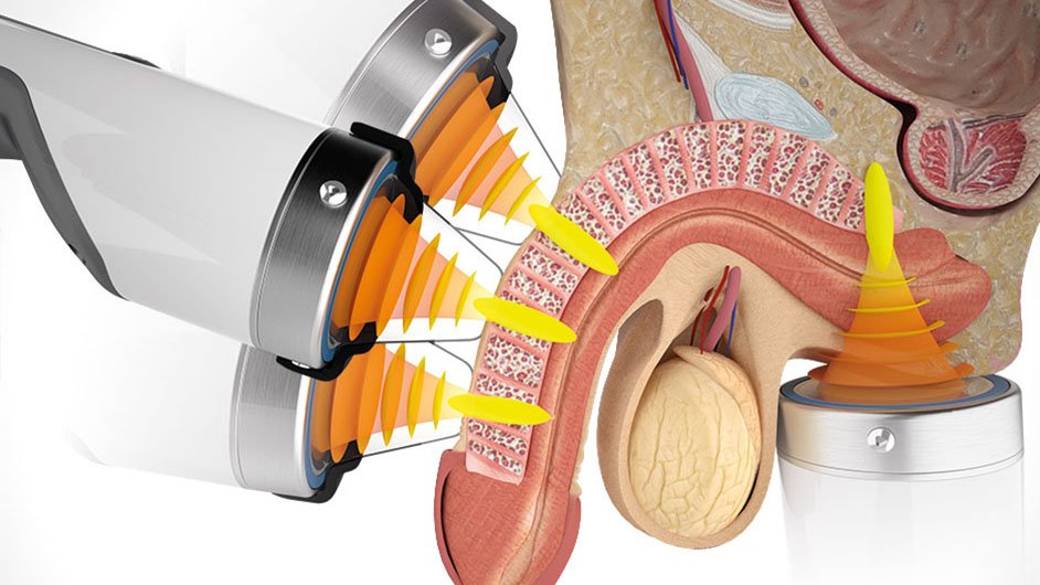 ondas de choque para fibroses